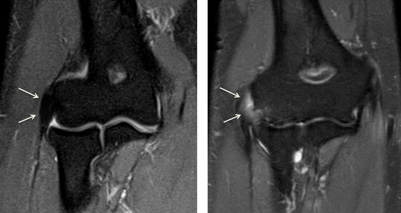 Tennis Elbow Lateral Epicondylitis Raleigh Hand Surgery — Joseph J