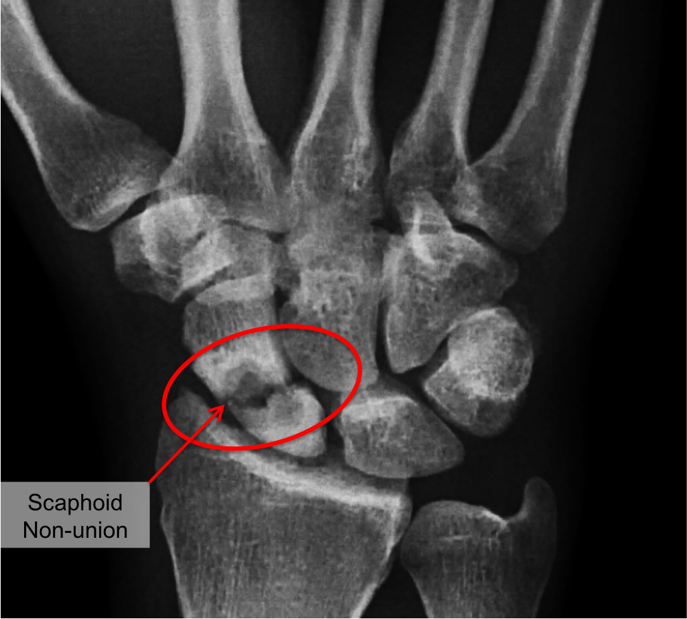 Scaphoid Fracture Raleigh Hand Surgery — Joseph J. Schreiber, MD