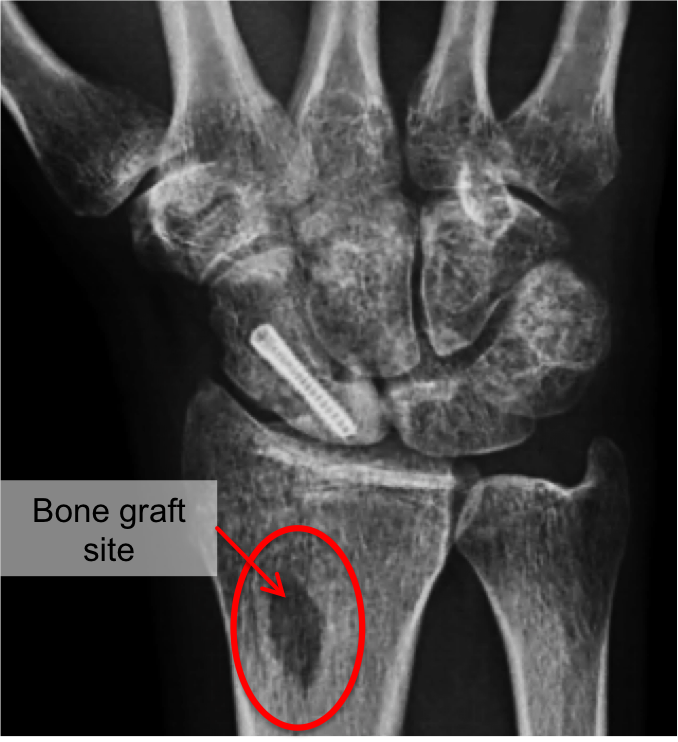 scaphoid fracture surgery