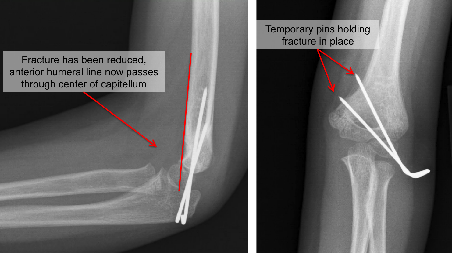 Kid S Elbow Fracture Raleigh Hand Surgery Joseph J Schreiber Md