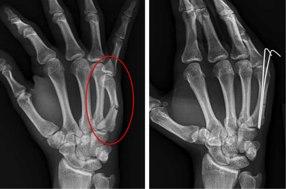 Hand Fracture - Raleigh Hand Surgery — Joseph J. Schreiber, MD