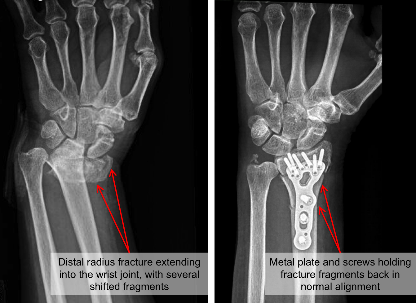 Distal Radius Bone Fracture