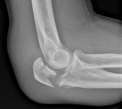 Olecranon Fracture - Raleigh Hand Surgery — Joseph J. Schreiber, MD