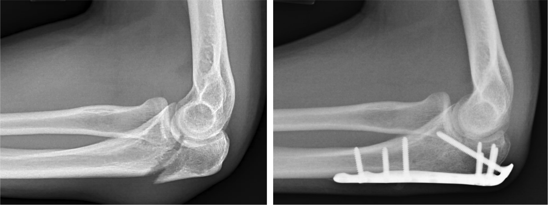 Orif Elbow Cpt Code , Elbow dislocation Codes – JDQM