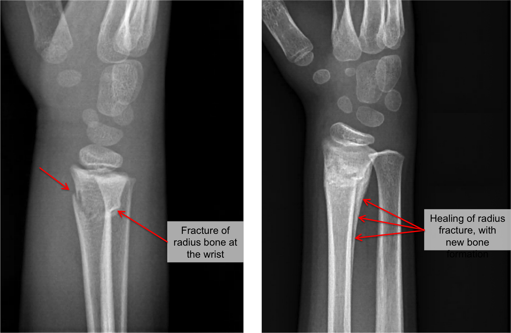 Buckle Fracture Raleigh Hand Surgery Joseph J Schreiber MD