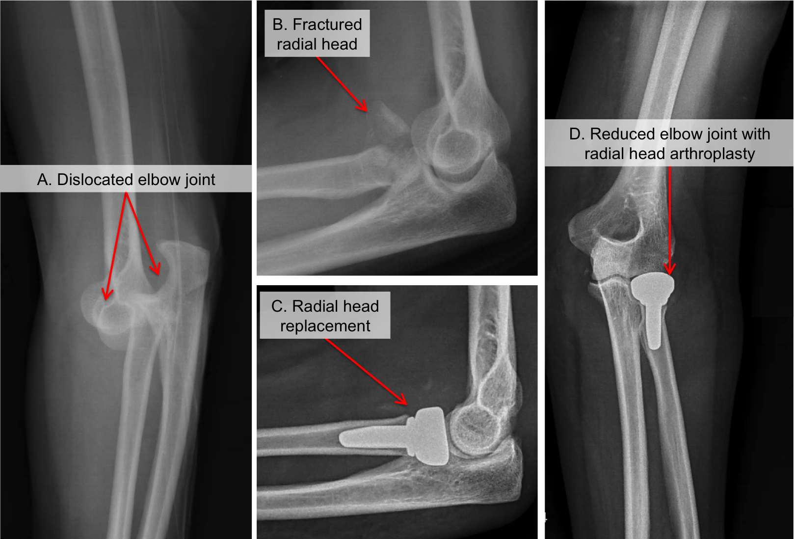 A case of bilateral elbow dislocation in a patient with Rubinstein