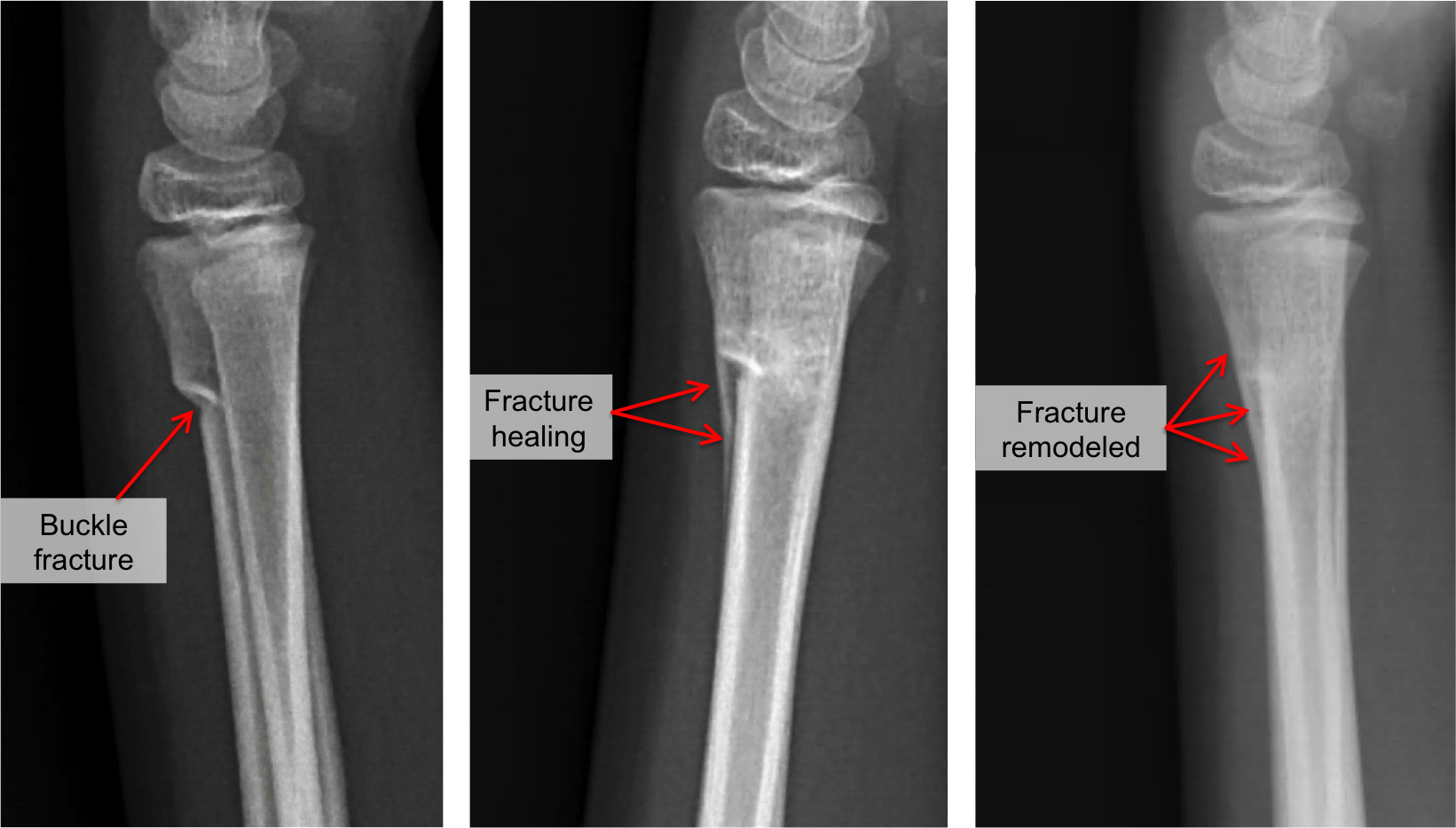 Buckle Fracture Raleigh Hand Surgery — Joseph J Schreiber Md