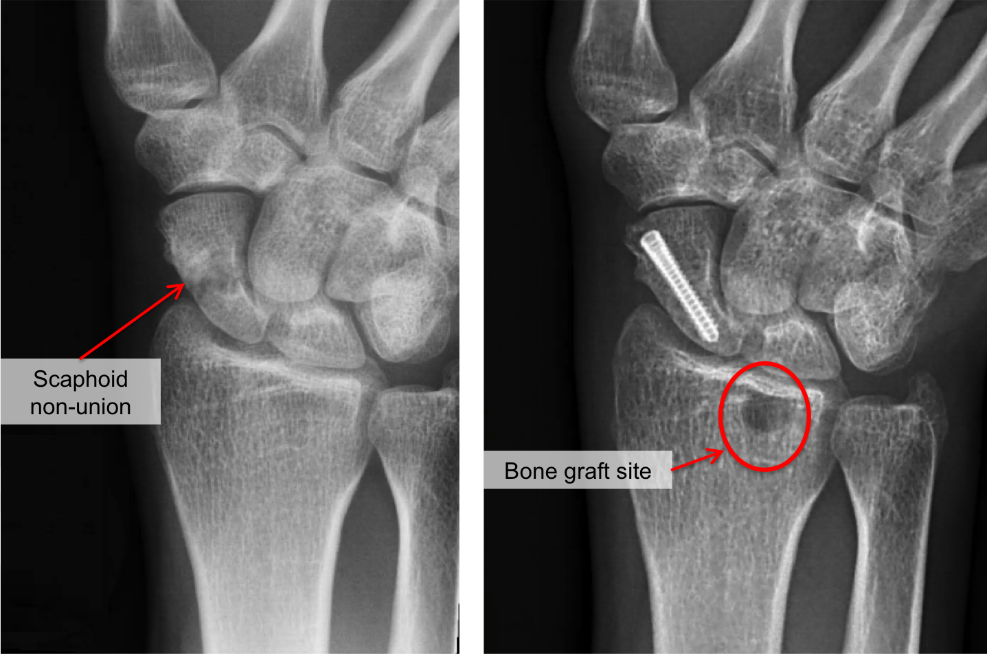 [Surgery for Pseudarthrosis of the Scaphoid Bone Performed in Hungary ], A scaphoid pseudarthrosis