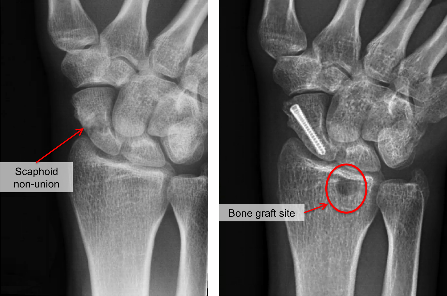 [Surgery for Pseudarthrosis of the Scaphoid Bone Performed in Hungary ], A scaphoid pseudarthrosis