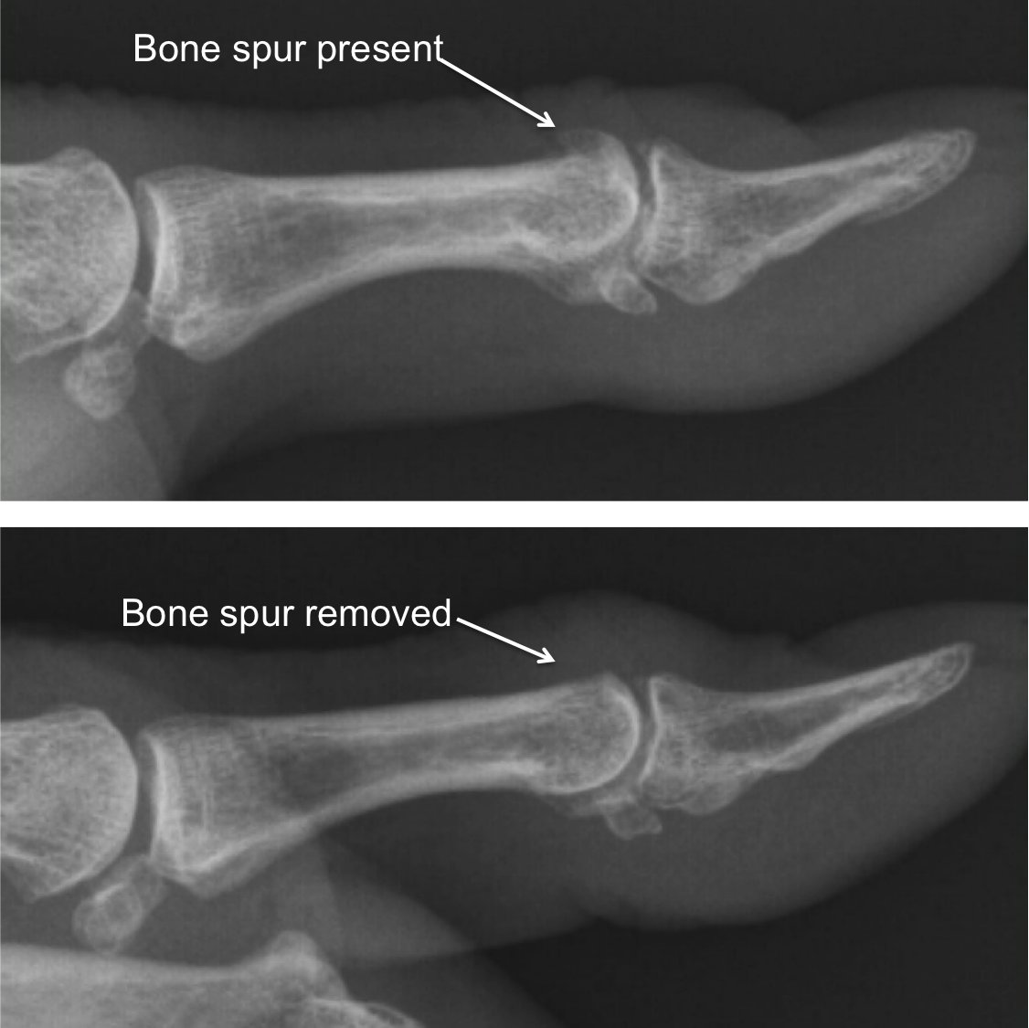 What Is A Cyst On The Bone? , Benign Bone Tumors and Cysts – AUIDFX