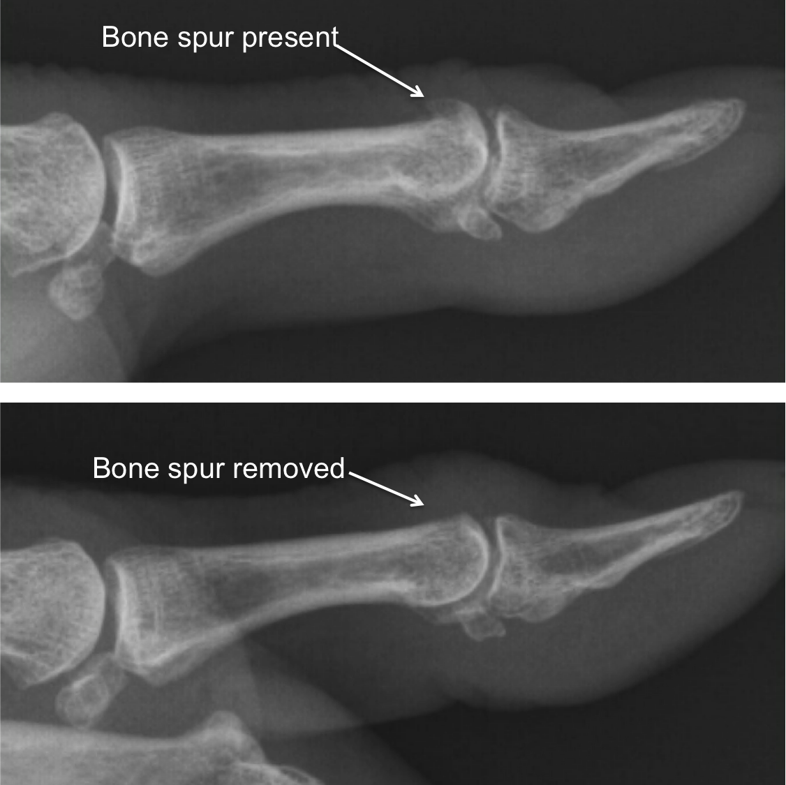 Ganglion Cysts Volar Retinacular Cysts Osmi Fort Wort - vrogue.co