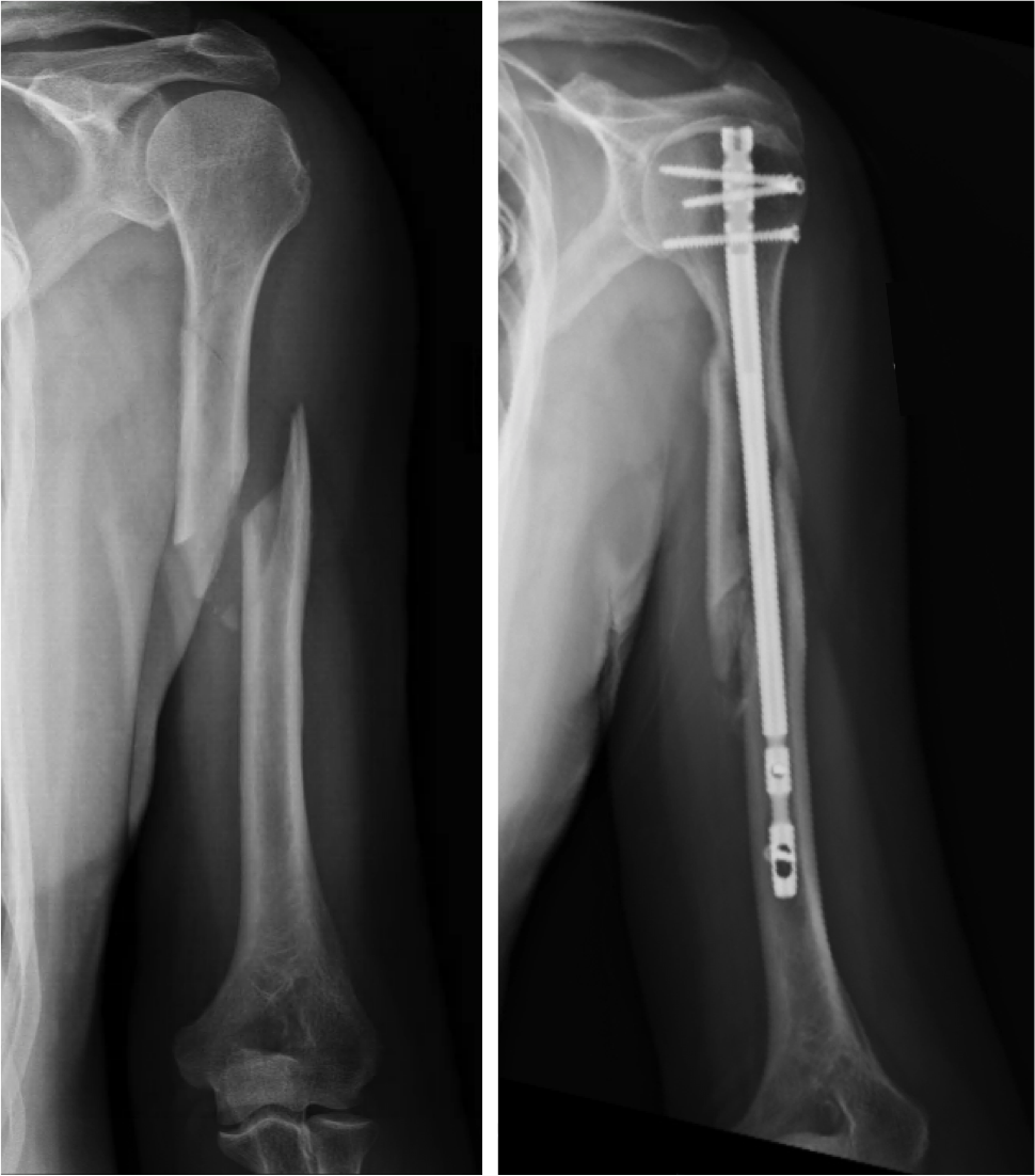 Shaft Of Humerus Fracture