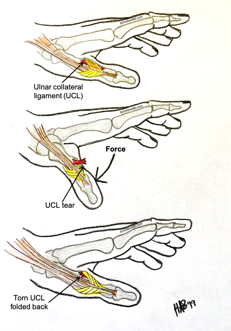 Thumb Ligaments Anatomy