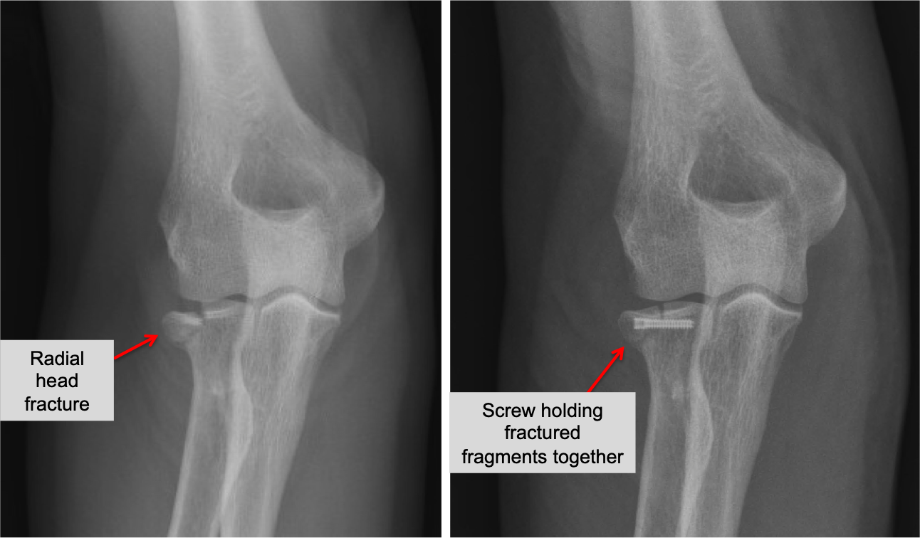 Patient 1: Radial head open reduction internal fixation (ORIF). The two pieces are lined up, and held in place with a metal screw.