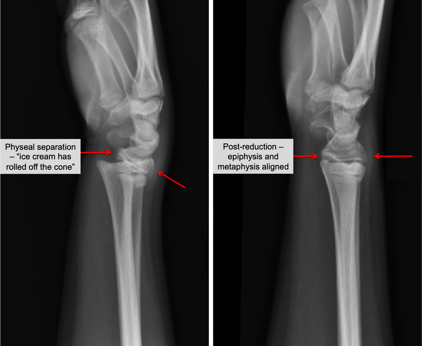 Kid's Wrist Fracture Raleigh Hand Surgery — Joseph J. Schreiber, MD