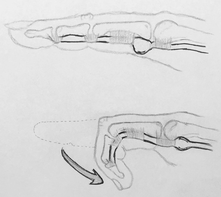 Trigger thumb is caused by swelling of the tendon that bends the finger. The abnormal nodule in the tendon prevents the tendon from gliding smoothly, resulting in clicking, catching, or locking when bending the thumb.