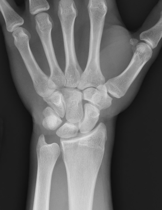 Normal Child Wrist X Ray
