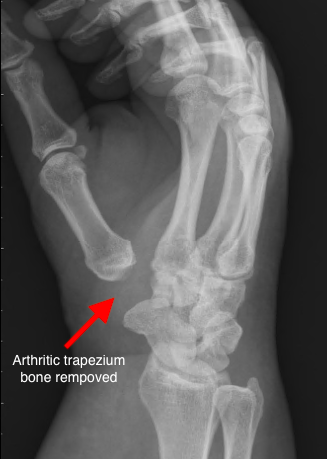 Thumb Arthritis - Raleigh Hand Surgery — Joseph J. Schreiber, MD