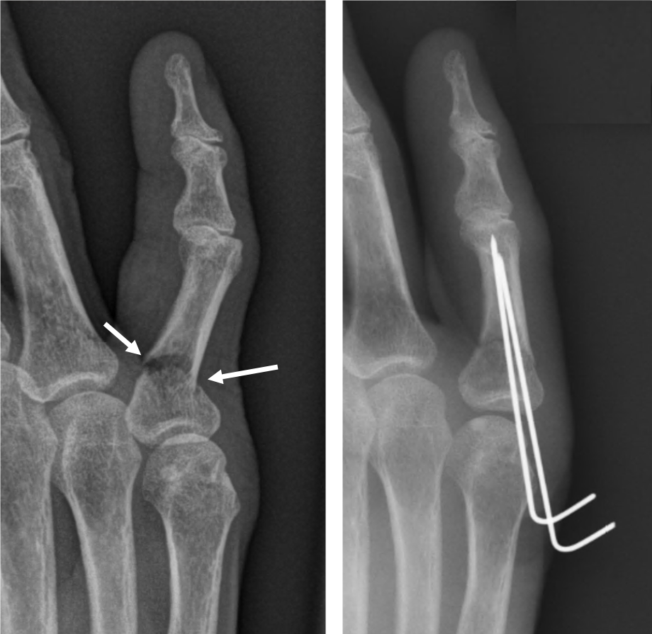 Update 142+ fracture proximal phalanx ring finger - awesomeenglish.edu.vn