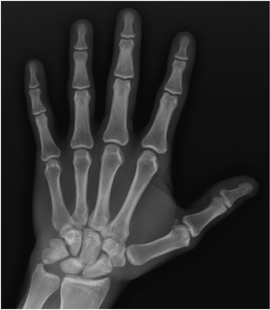 Hand Xray Hand Xray