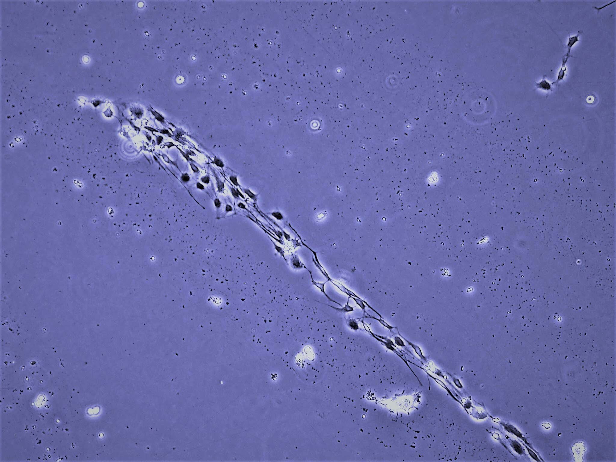 Glioblastoma cells braid