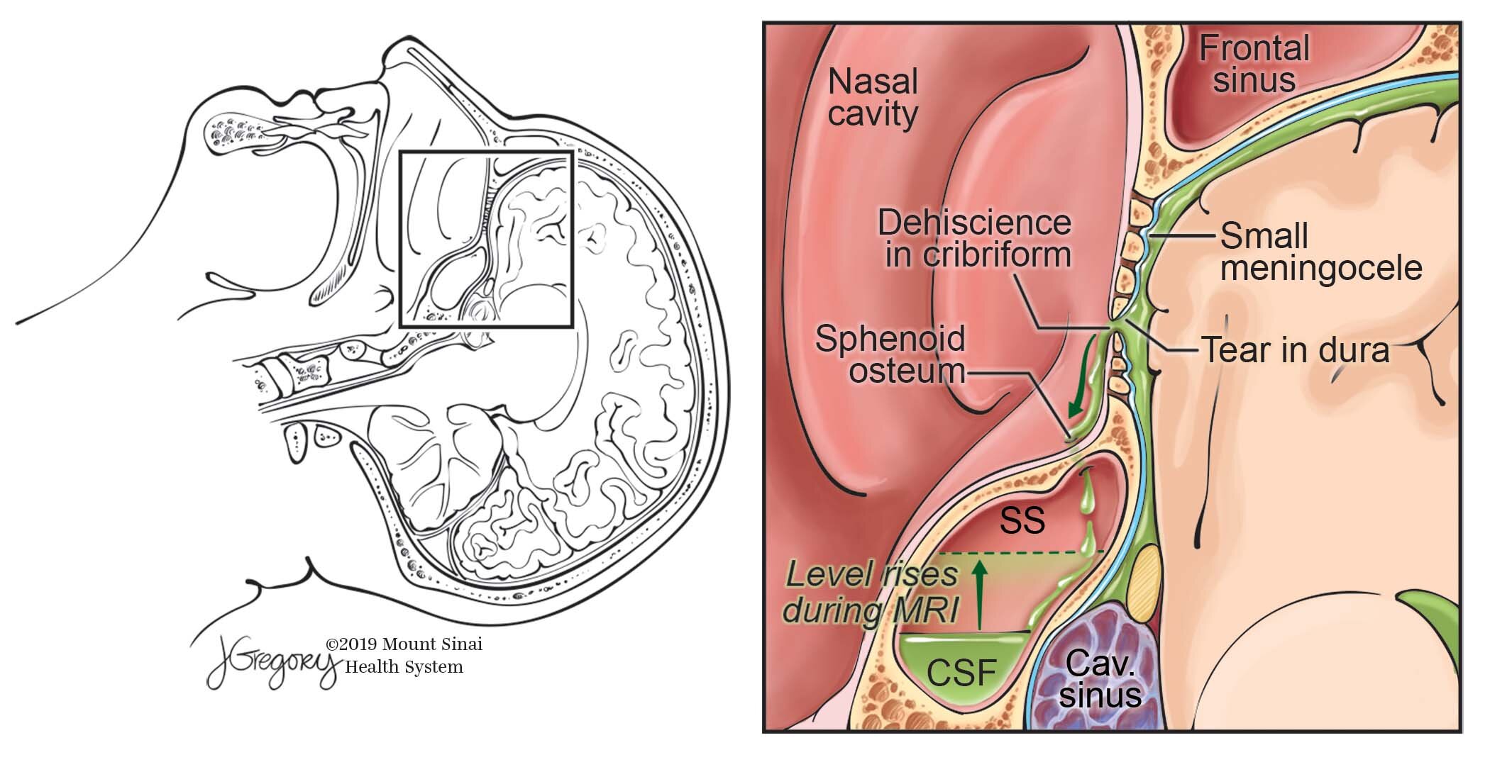CSF Leak through the Cribriform Plate