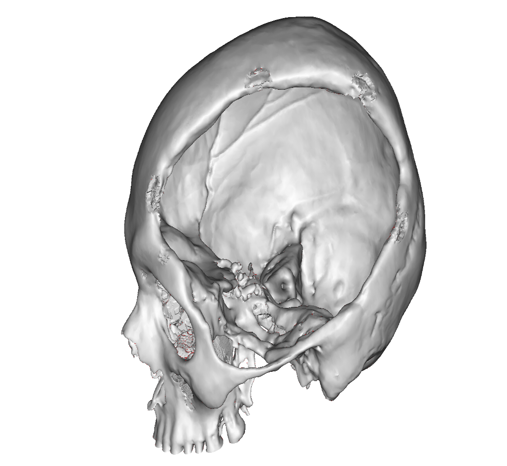 HTR - defect w bone.png