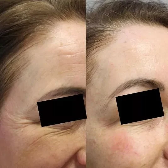 Next week is the last week for anti-wrinkle treatment before Christmas! ☃️🎅 We have very limited space left on Thursday 19th so we have opened up a few slots on 18th December, visit the link below or call us to book in!

www.theglensdentalpractice.c