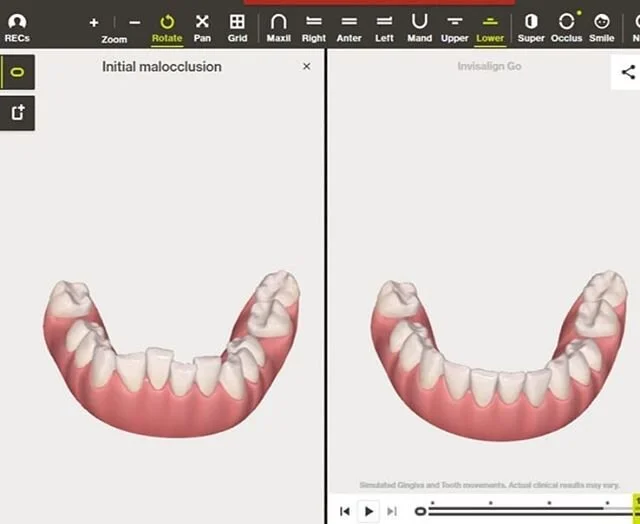 🥳 SPECIAL OFFER 🥳

For the month of February we are offering 20% OFF INVISALIGN!

That's a saving of &pound;560 off dual arch treatment and &pound;480 off single arch treatment!

Visit https://www.theglensdentalpractice.com/pagei or call us to book