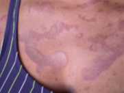 Patterns of skin rashes that cleared during detoxification