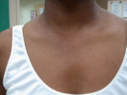 78 day detoxification program achieving 5000 mg niacin