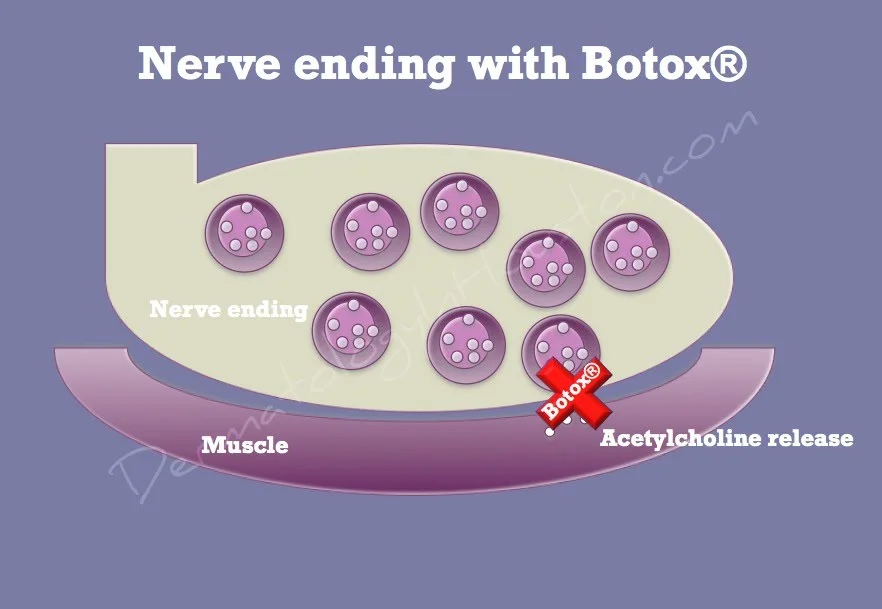 How Botox Works — Village Dermatology