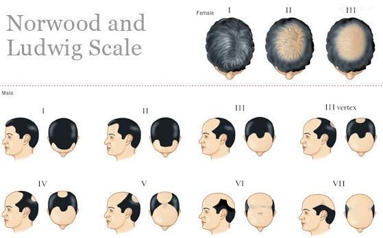 Male Pattern Hair Loss — Village Dermatology