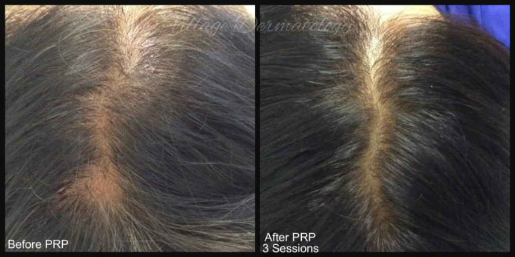RK before and after.jpg