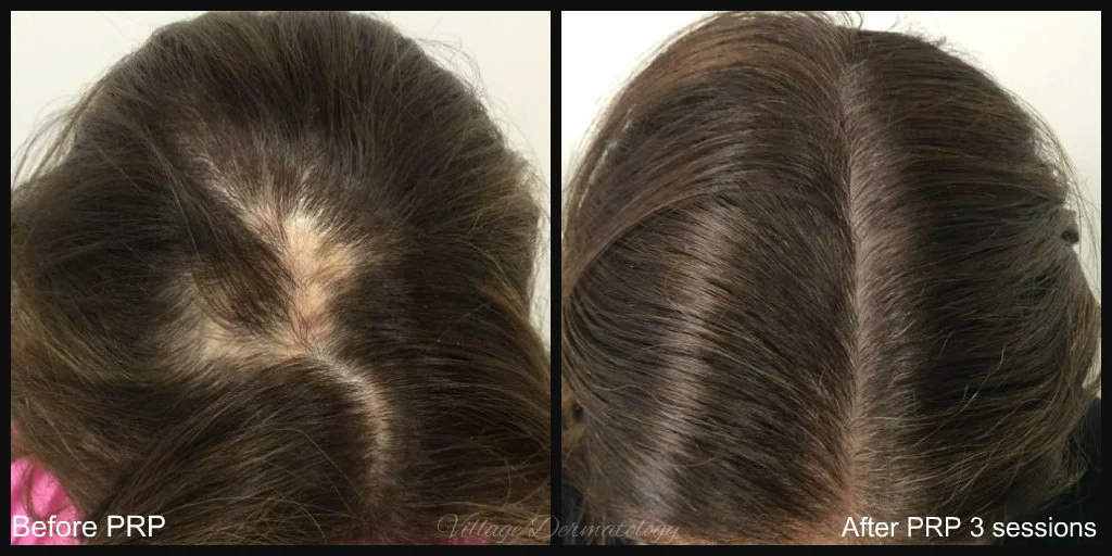 PRP for alopecia areata B and A.jpg