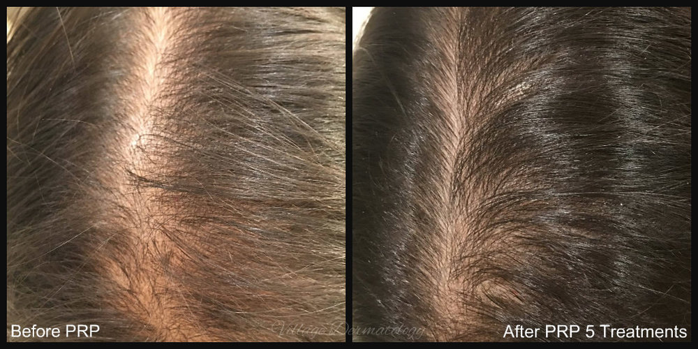 PRP Before and Afters — Village Dermatology