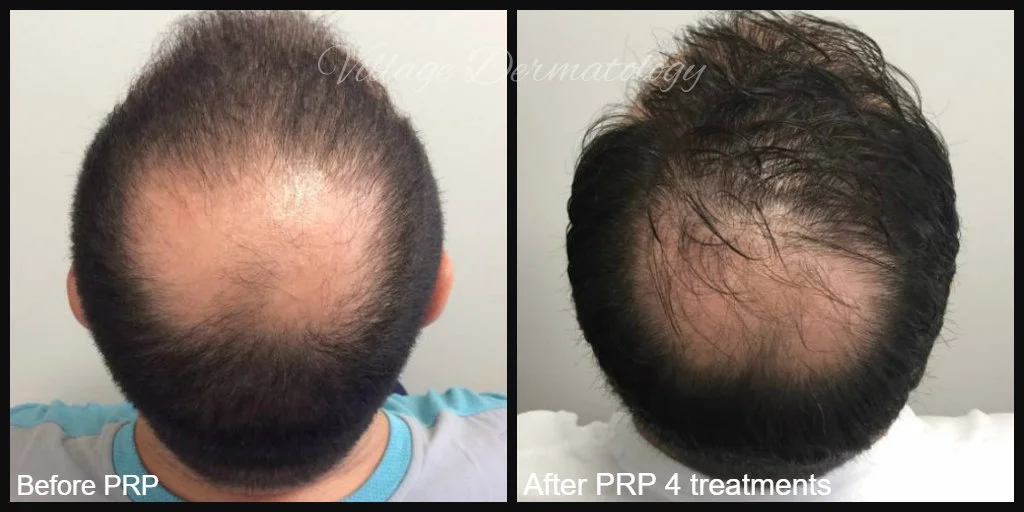 HS before and after.jpg