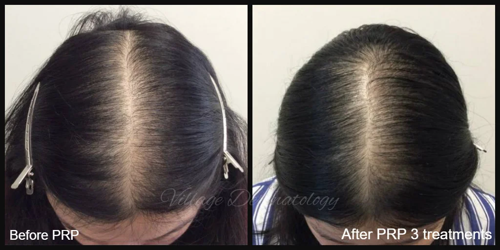 CL before and after.jpg