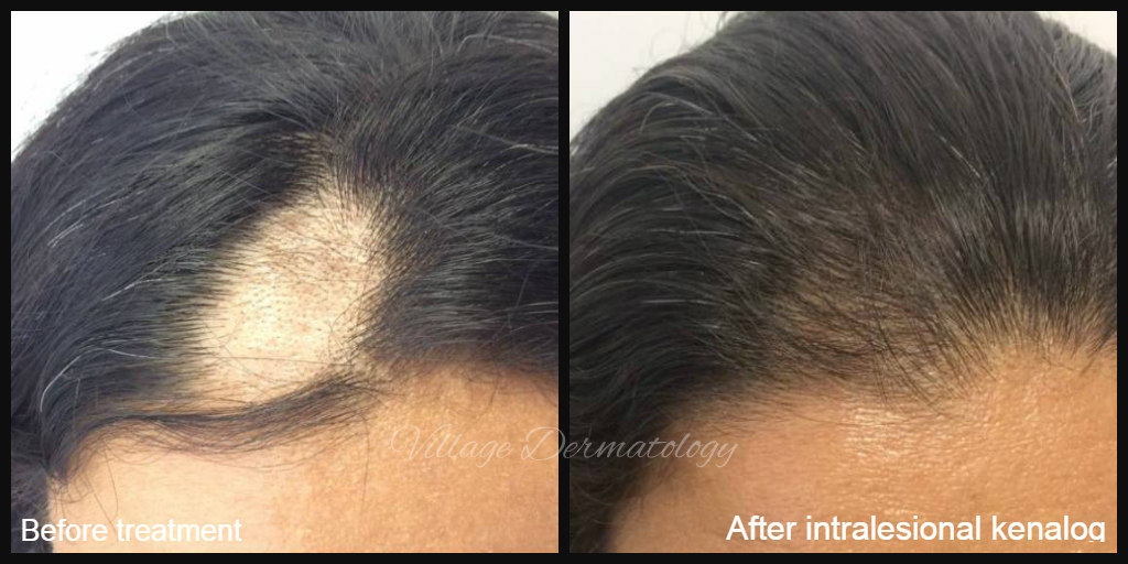Treatment of Alopecia Areata — Village Dermatology