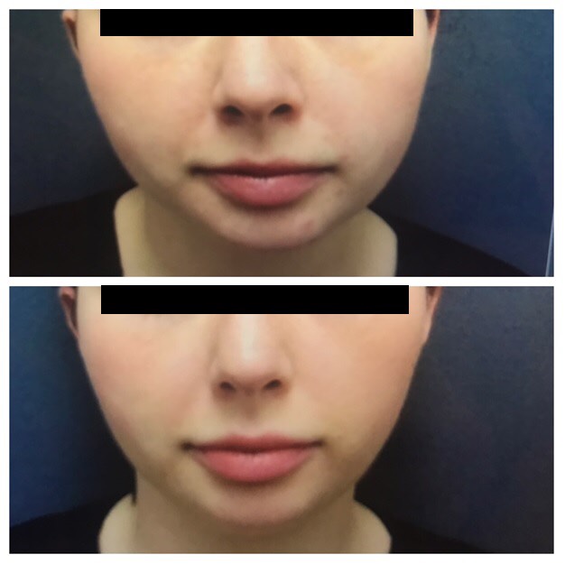 Botox Redo.jpg