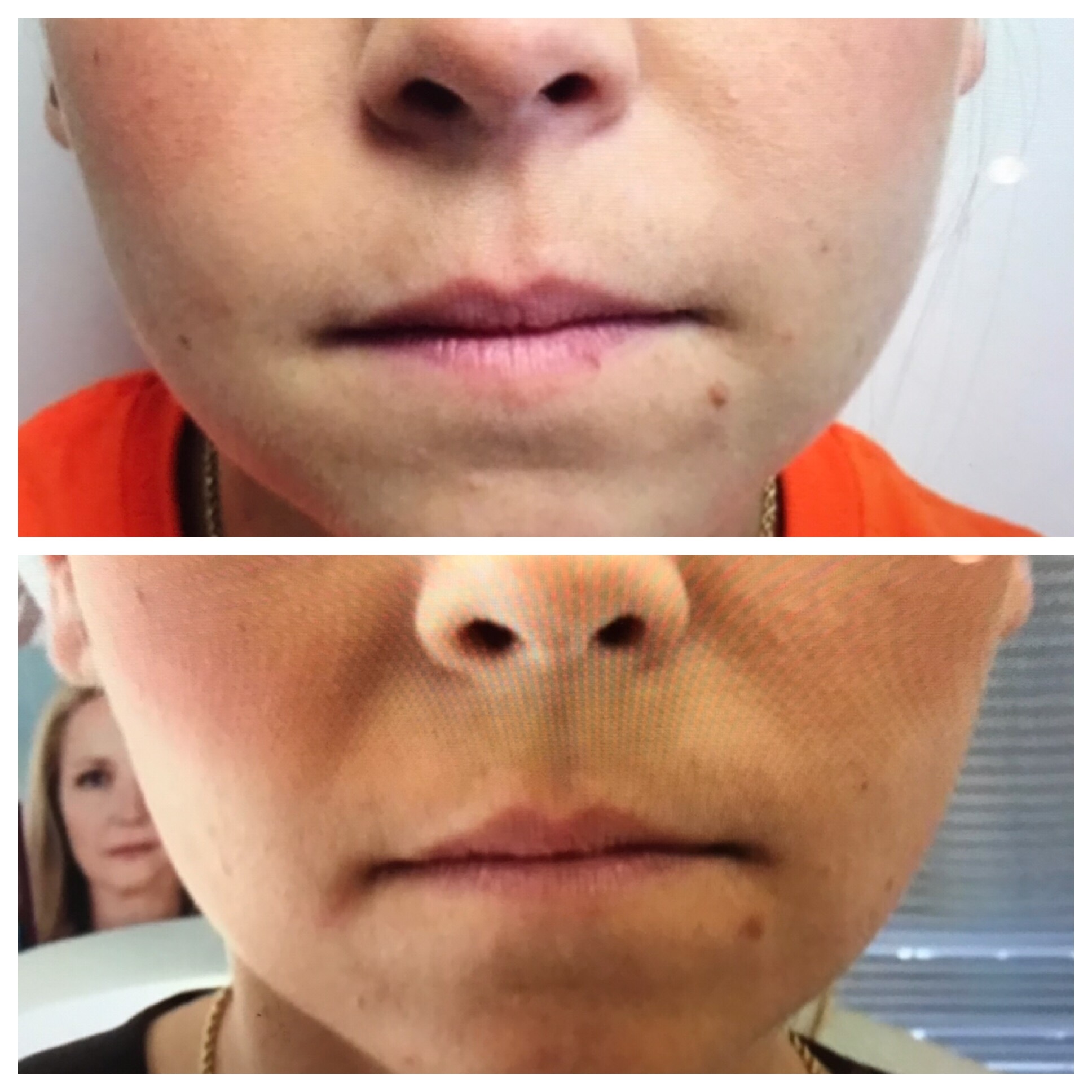 Botox7.jpg