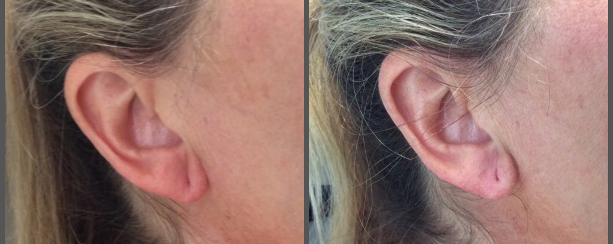 Earlobe filler restylane.jpg