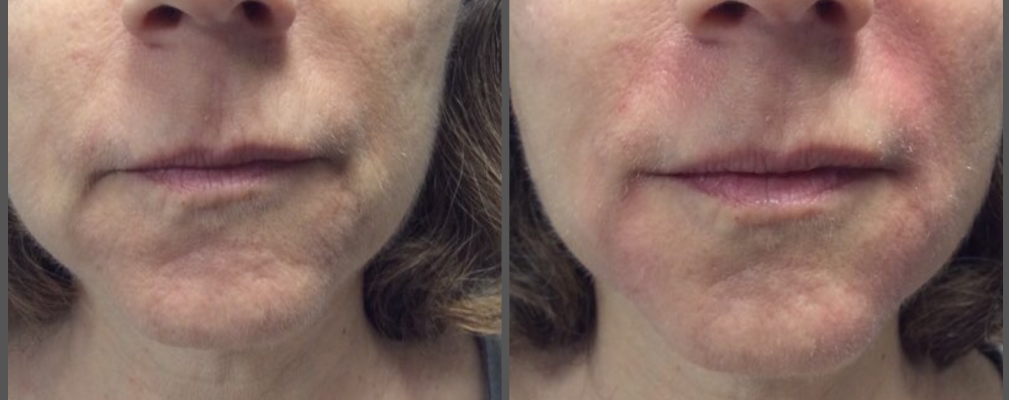 A little can go a long way. Smile lines, corners of the mouth and revolumizing the lower face. Our photos are not filtered the patient is red from molding the product. Micro-cannula used so the patient has zero bruising! 