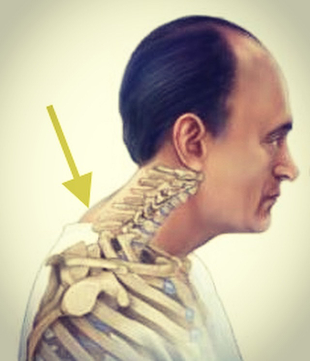 My Neck Has a Hump. Is That Normal?
