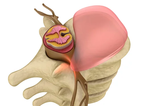Bulging Disc Chiropractor