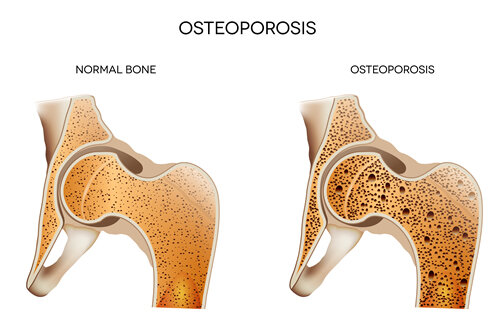 Ostoeporosis