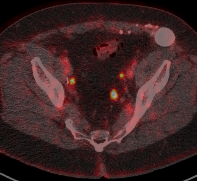 The PSMA-F18 PET scan is an experimental scan that is being investigated to prove its sensitivity and specificity for detecting prostate cancer.