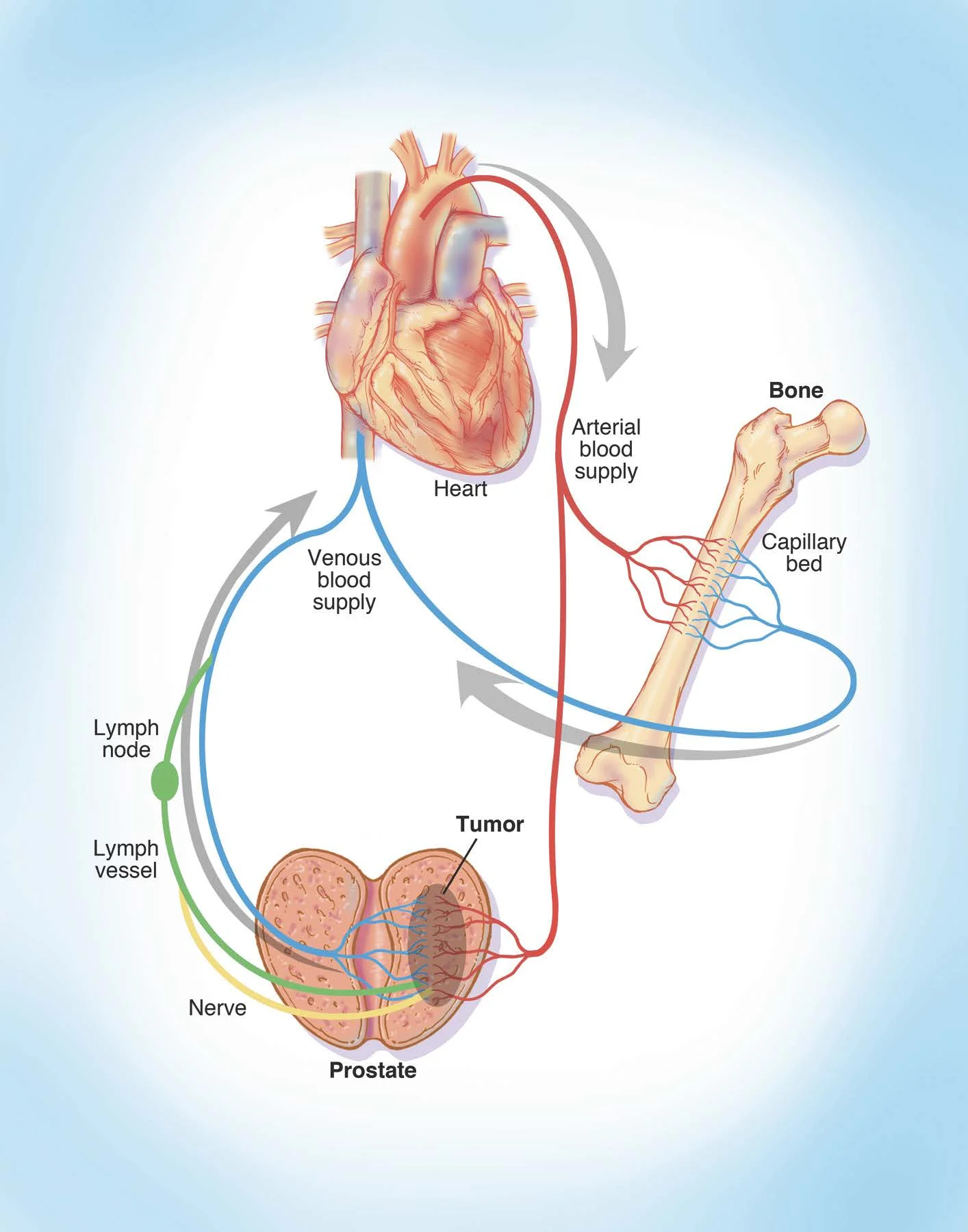 Prostate cancer diaspora: Cancer cells leave the primary tumor through various paths (lymphatics, nerves, blood vessels) and disperse through the blood stream to target organs. Nearly 100% of men with metastatic prostate cancer demonstrate involvement in the bones. 