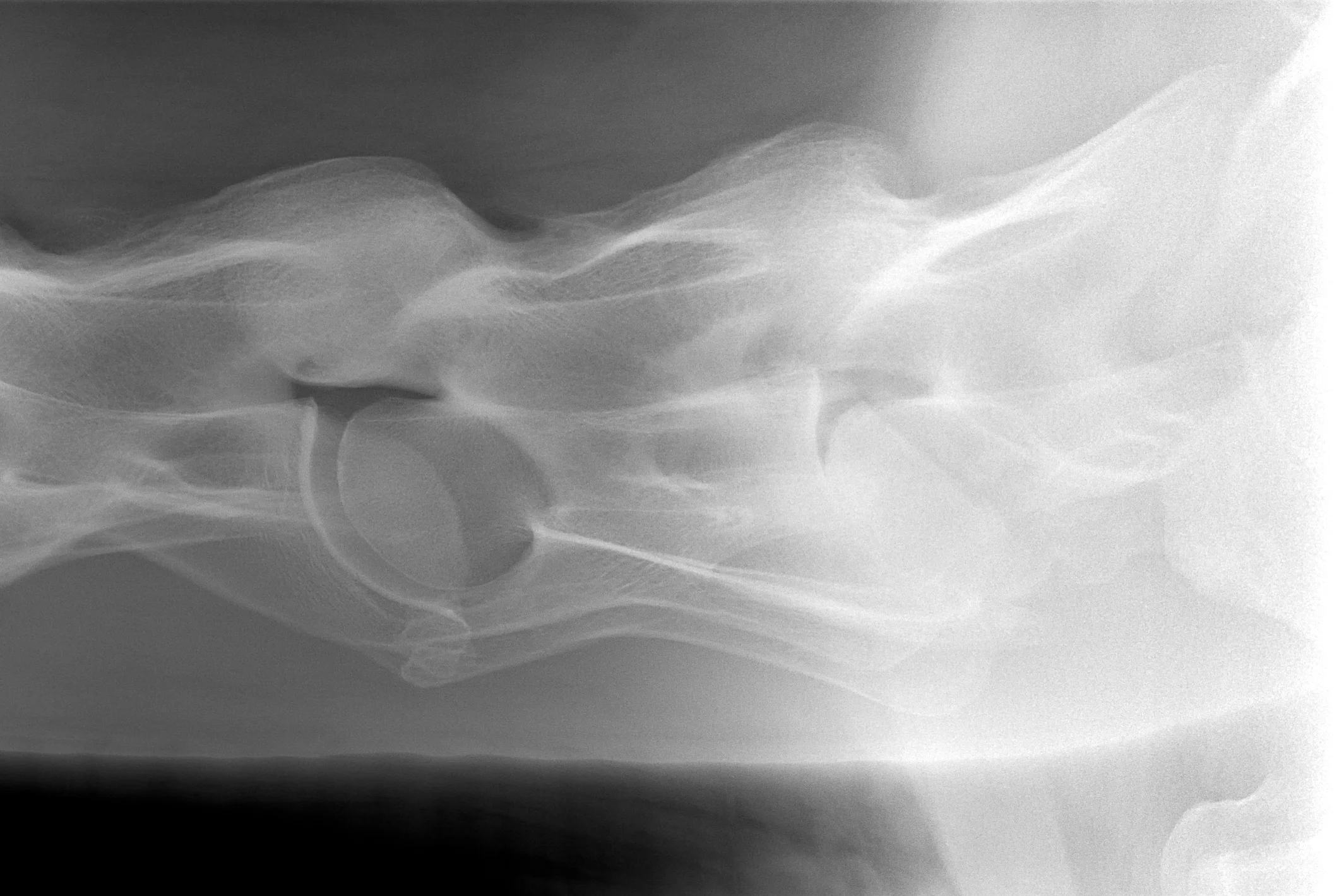 20170227-Cervical Spine Caudal.jpg