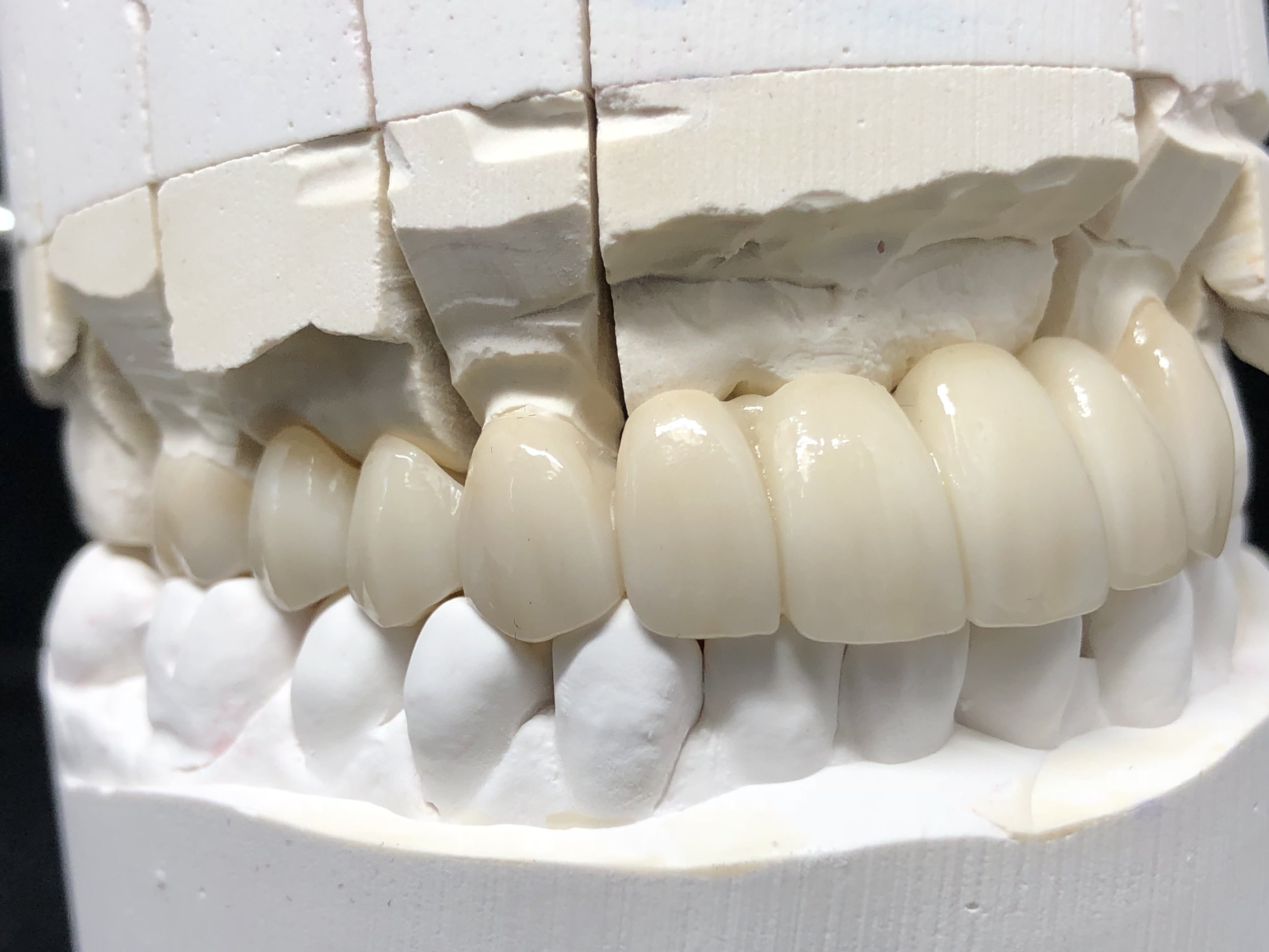  Full Contour Zirconia 